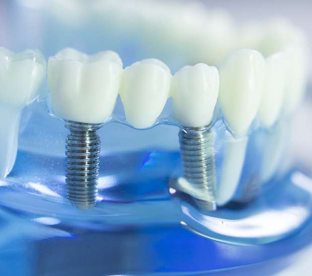 Davenport Dental Implants