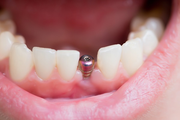 Implant Dentist Davenport, IA
