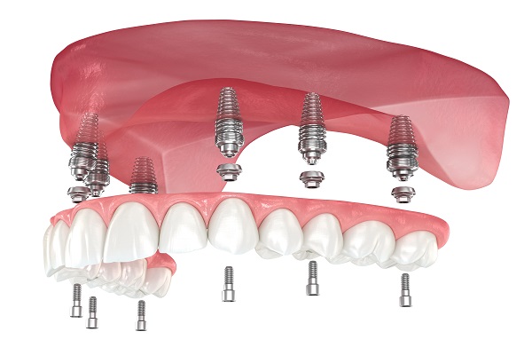 Implant Supported Dentures Davenport, IA