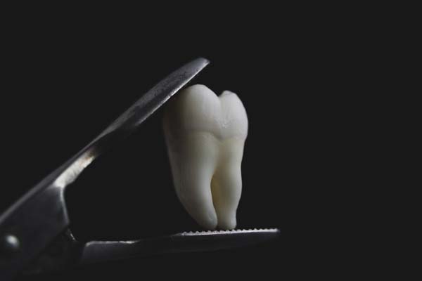 Tooth Extraction Davenport, IA
